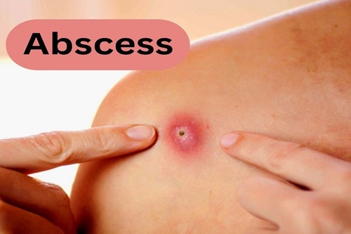 Abscess Homeopathy Treatment in Thane, Mumbai