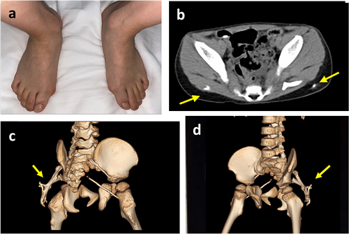 Fibrodysplasia Ossificans Progressiva