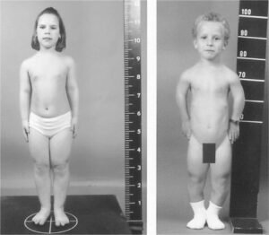 Acromesomelic Dysplasia - Symptoms, Causes, Treatment