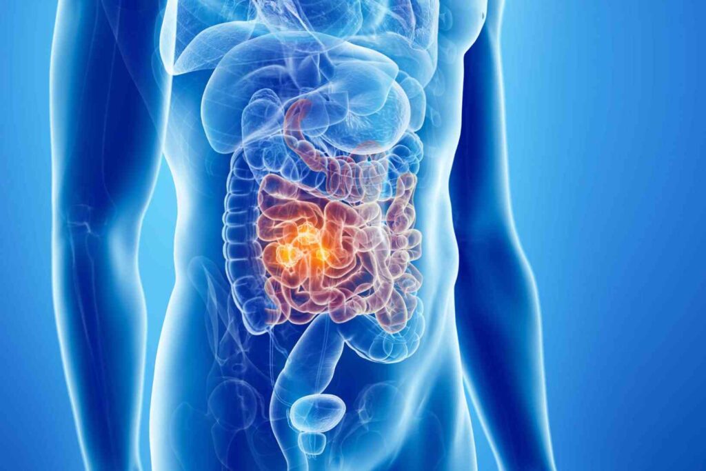 Acute Intestinal Obstruction