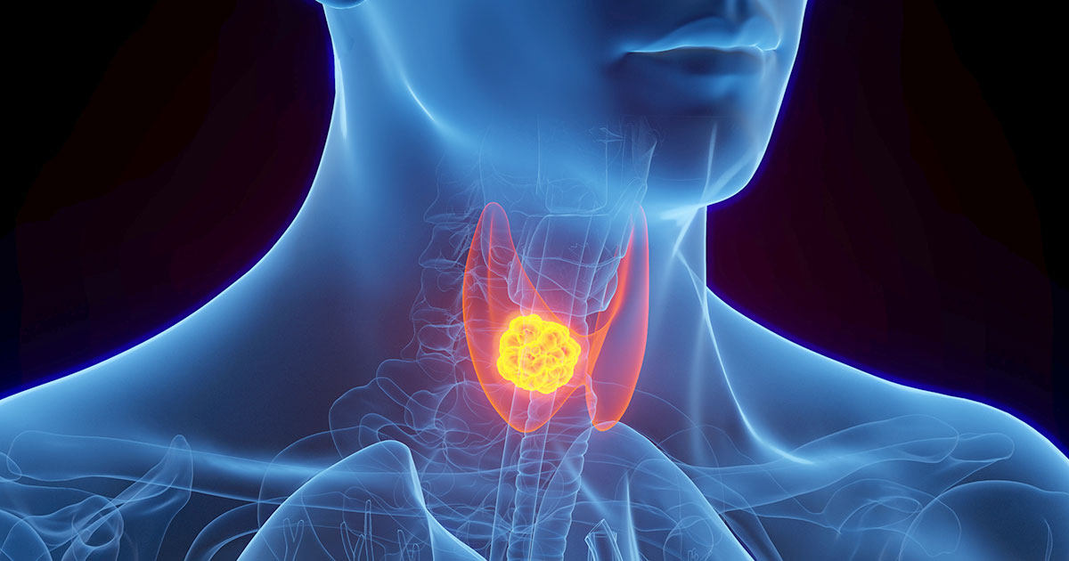 Homeopathic Remedies for Thyroid | Natural Thyroid Care