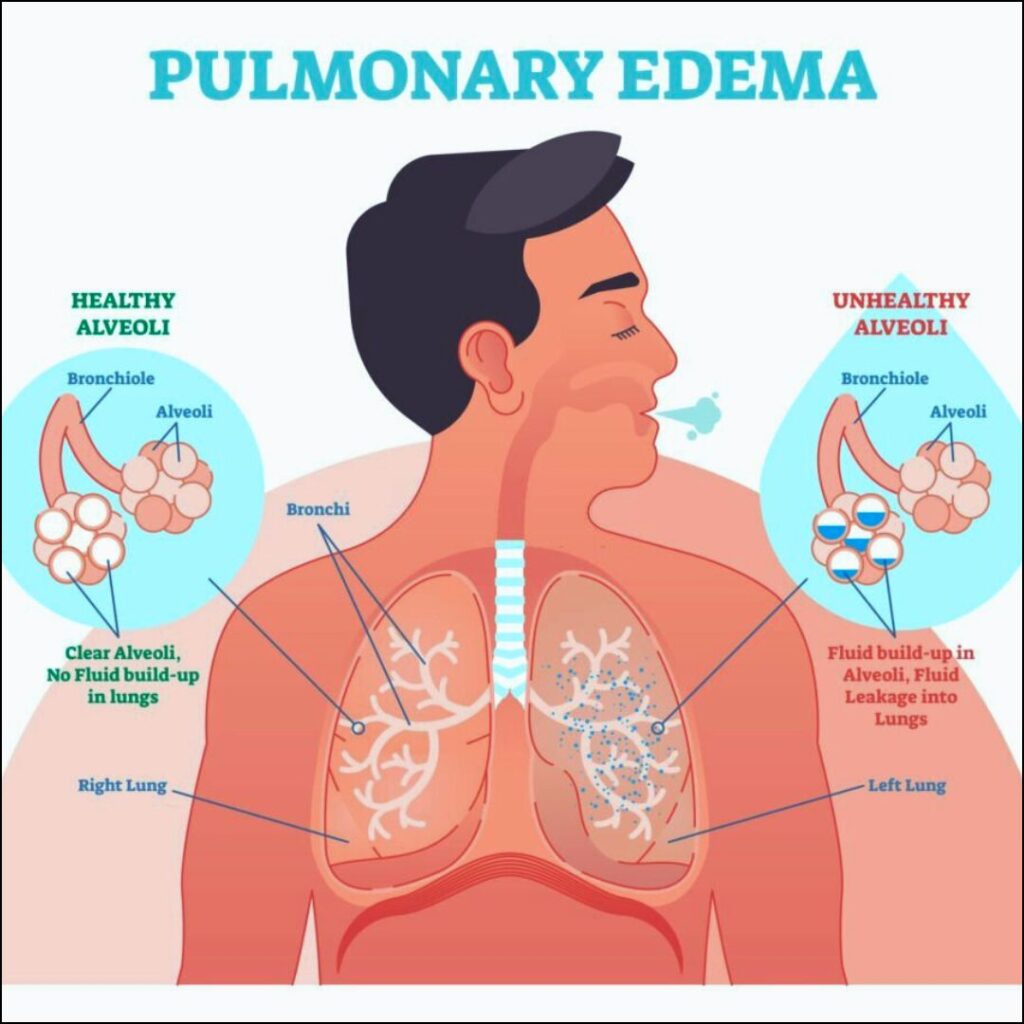 Pulmonary edema in elderly lungs fluid buildup breathing problem illustration